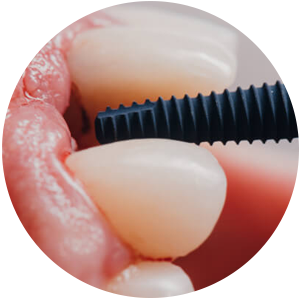 Implantes dentários