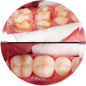 Restauração onlay e inlay