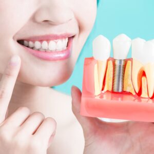 Implante dentário em Curitiba