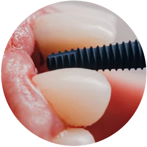 Implantes dentários