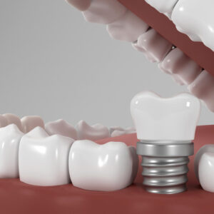 imagem de um implante dentario