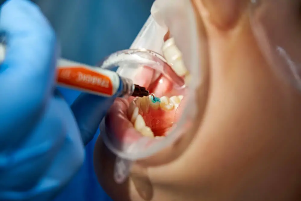 Dentista fazendo um tratamento odontológico em uma paciente do sexo feminino.